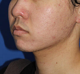20代男性の小林式ニキビ治療法 After 症例写真