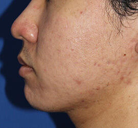 20代男性の小林式ニキビ治療法 After 症例写真