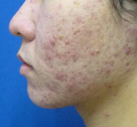 20代男性の小林式ニキビ治療法 Before 症例写真