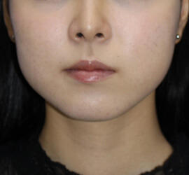 10代女性の小林式ニキビ治療法 After 症例写真