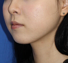 10代女性の小林式ニキビ治療法 After 症例写真