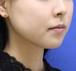 10代女性の小林式ニキビ治療法 After 症例写真
