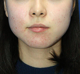 10代女性の小林式ニキビ治療法 Before 症例写真