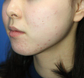 10代女性の小林式ニキビ治療法 Before 症例写真