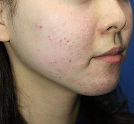 10代女性の小林式ニキビ治療法 Before 症例写真