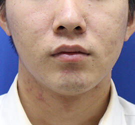 20代男性の小林式ニキビ治療法 After 症例写真