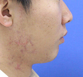 20代男性の小林式ニキビ治療法 After 症例写真