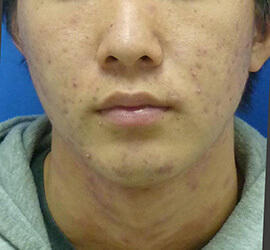 20代男性の小林式ニキビ治療法 Before 症例写真