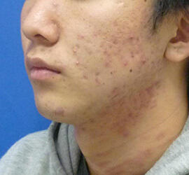 20代男性の小林式ニキビ治療法 Before 症例写真