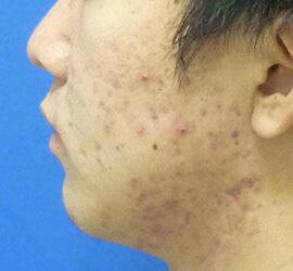20代男性の小林式ニキビ治療法 Before 症例写真