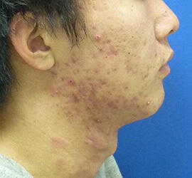 20代男性の小林式ニキビ治療法 Before 症例写真
