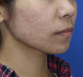 20代女性の小林式ニキビ治療法 After 症例写真
