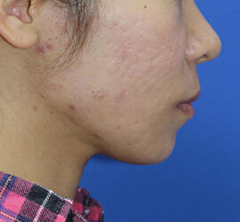 20代女性の小林式ニキビ治療法 After 症例写真