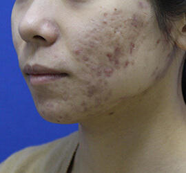 20代女性の小林式ニキビ治療法 Before 症例写真