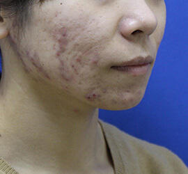 20代女性の小林式ニキビ治療法 Before 症例写真