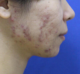 20代女性の小林式ニキビ治療法 Before 症例写真