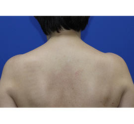 60代女性のボトックス（美肩・肩こり解消） After 症例写真