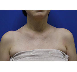 60代女性のボトックス（美肩・肩こり解消） After 症例写真