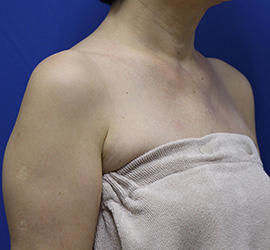 60代女性のボトックス（美肩・肩こり解消） After 症例写真