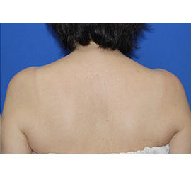 60代女性のボトックス（美肩・肩こり解消） Before 症例写真