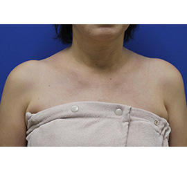 60代女性のボトックス（美肩・肩こり解消） Before 症例写真