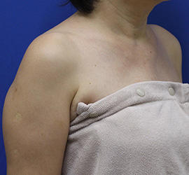 60代女性のボトックス（美肩・肩こり解消） Before 症例写真