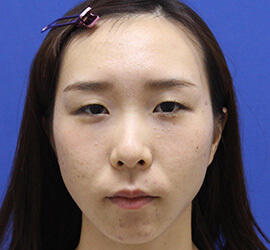20代女性の小林式ニキビ治療法 After 症例写真