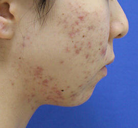 20代女性の小林式ニキビ治療法 Before 症例写真