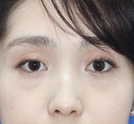 30代女性の目の下のクマ治療 After 症例写真