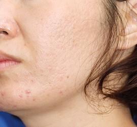 30代女性のフラクセル After 症例写真