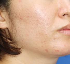 30代女性のフラクセル After 症例写真