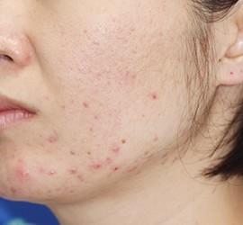 30代女性のフラクセル Before 症例写真