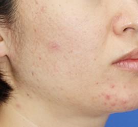 30代女性のフラクセル Before 症例写真