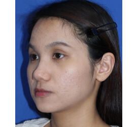 10代女性の小林式ニキビ治療法 After 症例写真