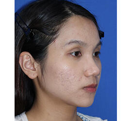 10代女性の小林式ニキビ治療法 After 症例写真
