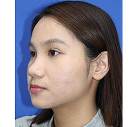 10代女性の小林式ニキビ治療法 Before 症例写真