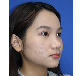 10代女性の小林式ニキビ治療法 Before 症例写真