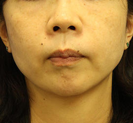 40代女性の顔の脂肪吸引  After 症例写真