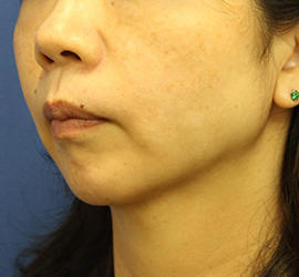 40代女性のシワ・たるみ After 症例写真