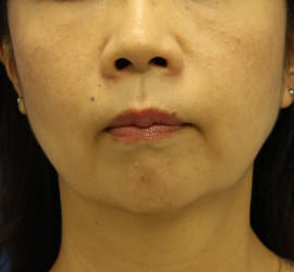 40代女性の顔の脂肪吸引  Before 症例写真