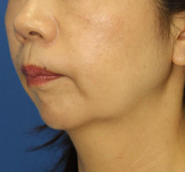 40代女性のシワ・たるみ Before 症例写真