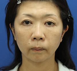 50代女性のシワ・たるみ After 症例写真