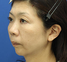 50代女性の肌再生高純度脂肪注入（脂肪移植） After 症例写真