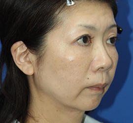 50代女性の肌再生高純度脂肪注入（脂肪移植） After 症例写真