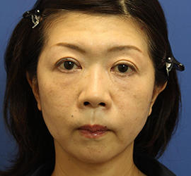 50代女性のシワ・たるみ Before 症例写真