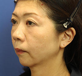 50代女性の肌再生高純度脂肪注入（脂肪移植） Before 症例写真
