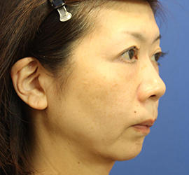 50代女性の肌再生高純度脂肪注入（脂肪移植） Before 症例写真