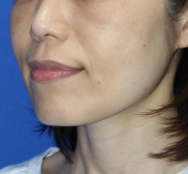 50代女性のレーザートーニング After 症例写真