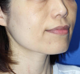 50代女性のレーザートーニング After 症例写真