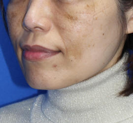 50代女性のレーザートーニング Before 症例写真